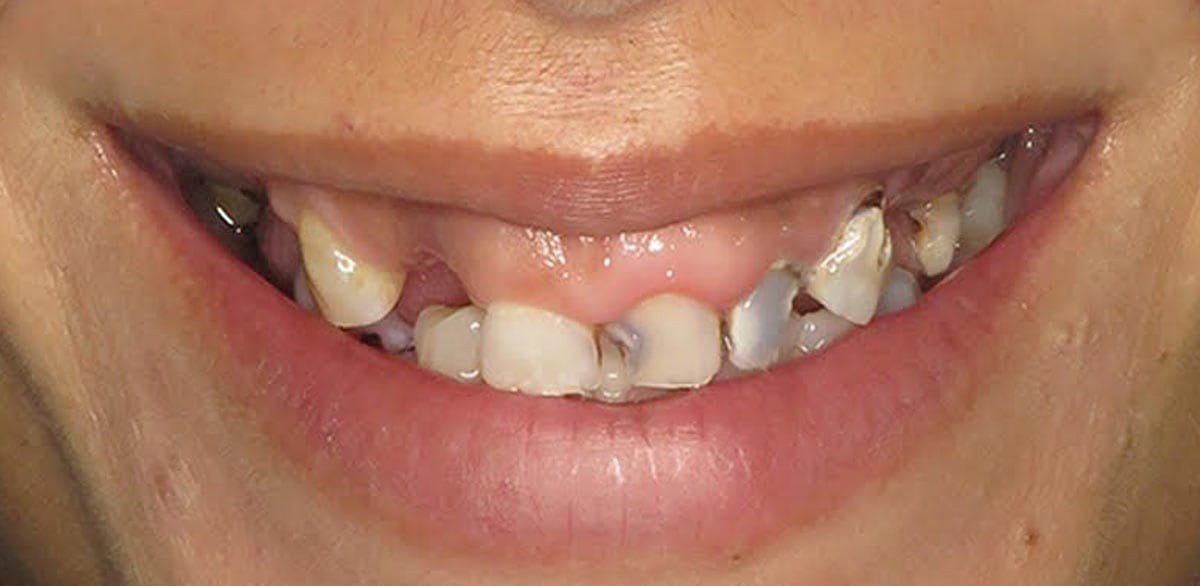 Before full-arch implant restoration