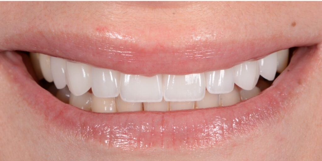 After porcelain veneers