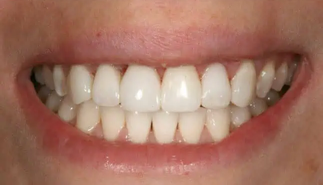 After implant #7