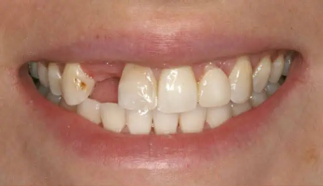 Before implant #7