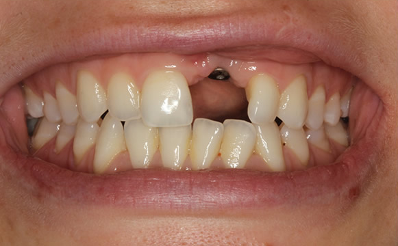 Before front-tooth implant