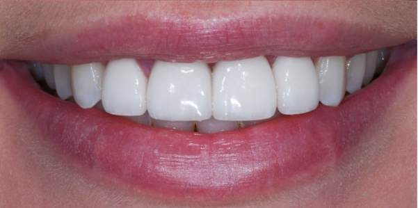Implant-supported restoration